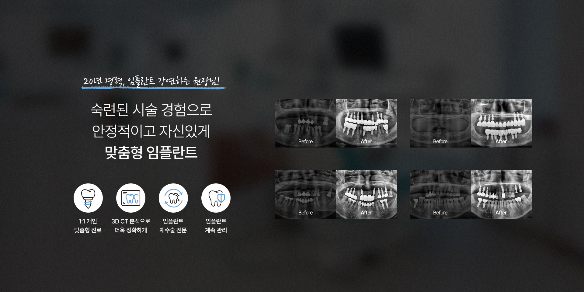 맞춤형 임플란트 진료 안내